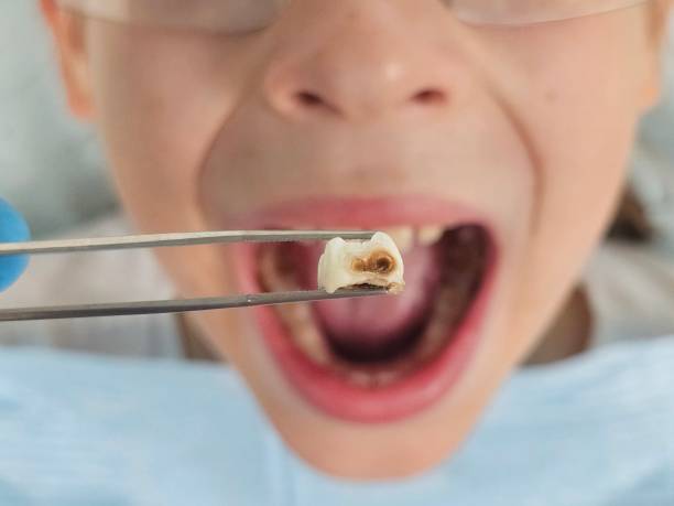 Best Emergency Dental Extractions in Colusa, CA